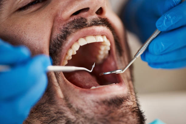 Best Chipped Tooth Repair Near Me  in South Pasadena, FL